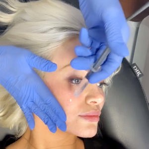 Microneedling